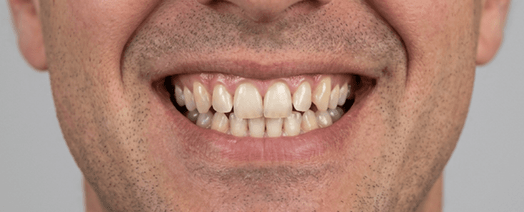 After treatment, Case 1