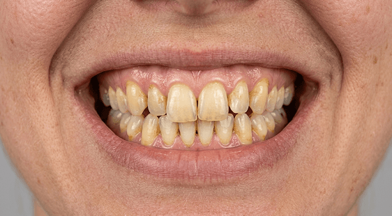 After treatment, Case 2